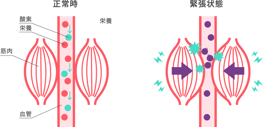 筋肉の正常時と緊張状態のイメージ図